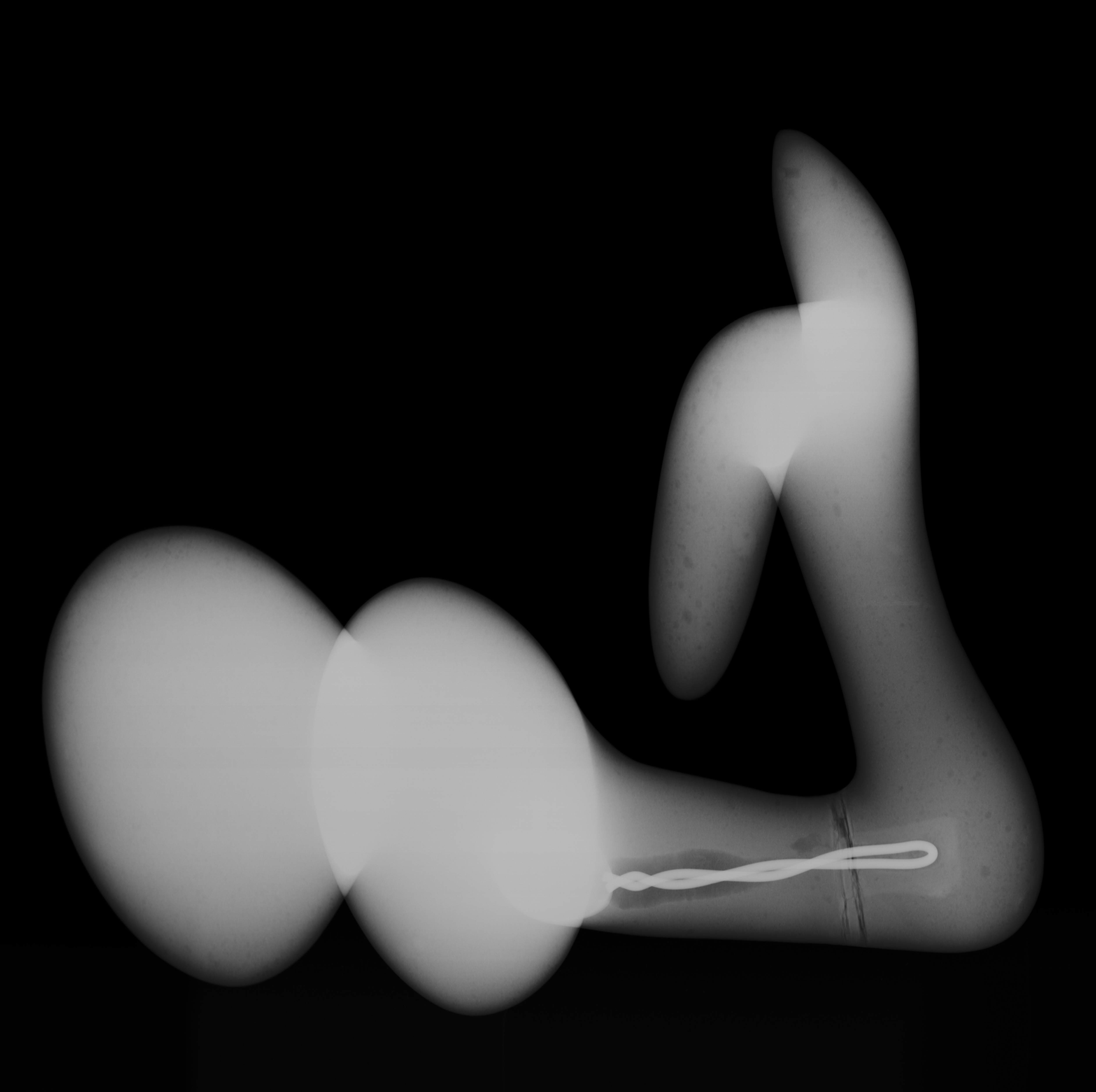 Hans Arp, Sirene, 1968-1969 (røntgenfotografi).